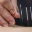 Acupuncture for Infertility Treatment